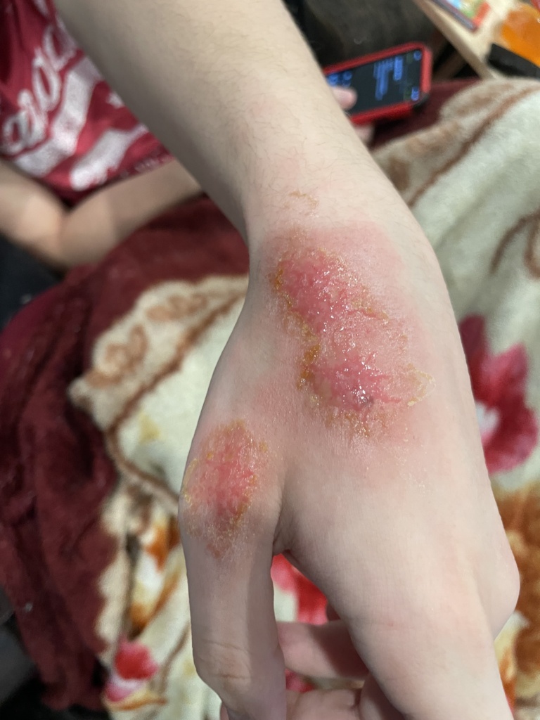 His hand after topical antibiotics