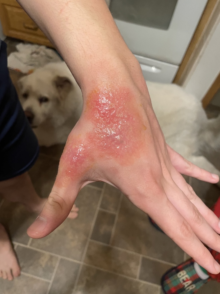 His hand after oral antibiotics. 